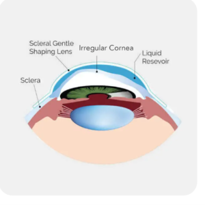 Scleral Lenses - Specialized Vision Correction for Dry Eyes and Keratoconus